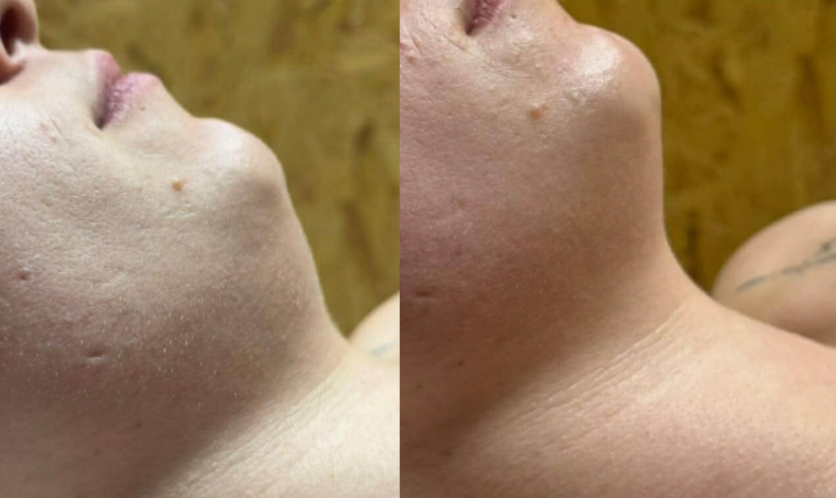 Efekty zabiegu Magnifico II Premium - poprawa owalu twarzy, porównanie przed i po