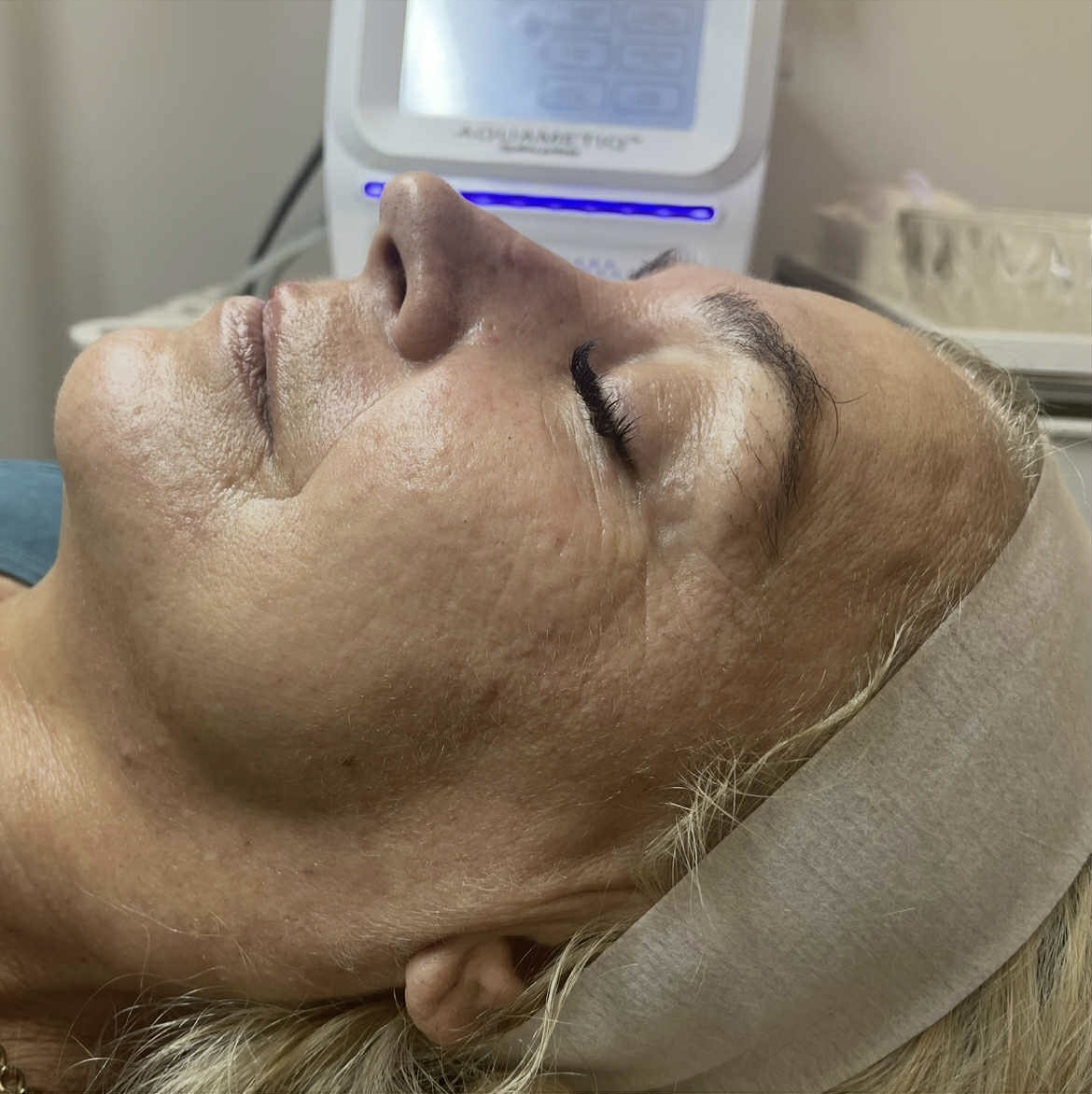 Zdjęcie twarzy po zabiegu Magnifico II Premium