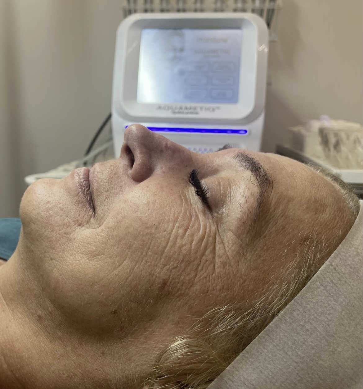 Zdjęcie twarzy przed zabiegiem Magnifico II Premium