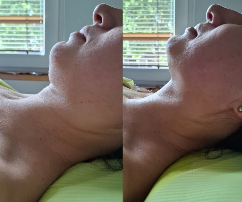 Efekty zabiegu Magnifico II Premium - lifting szyi i podbródka, porównanie przed i po